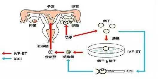 温州试管婴儿